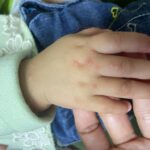 TENDINITIS ANSERINA: El dolor en las rodillas que no suele diagnosticarse oportunamente